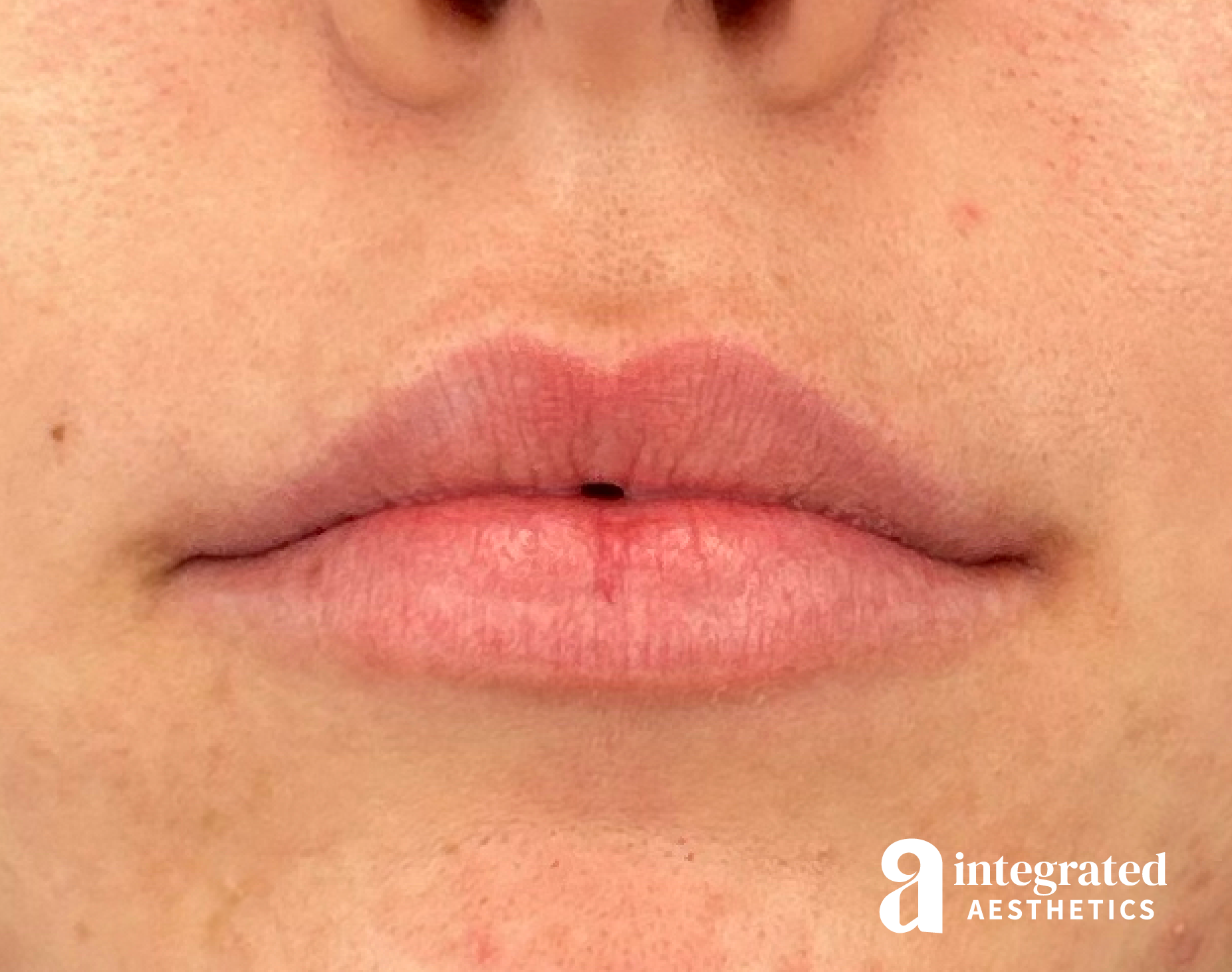 Lip Filler Before & After Gallery - Patient 320036 - Image 1