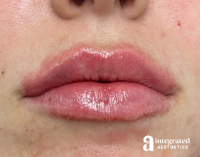 Lip Filler Before & After Gallery - Patient 320036 - Image 2