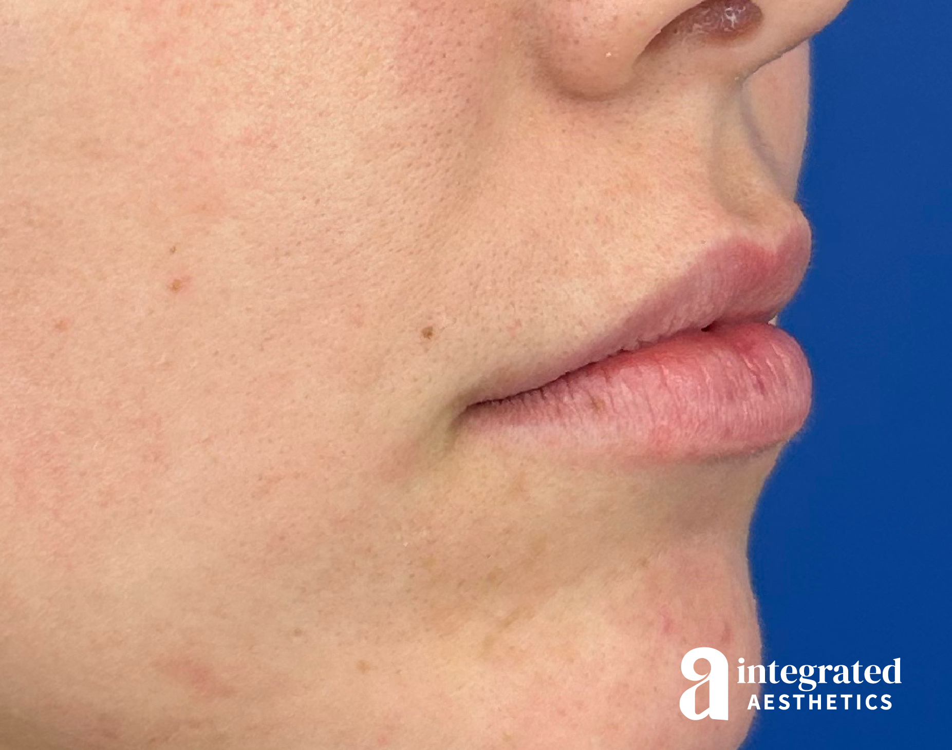 Lip Filler Before & After Gallery - Patient 320036 - Image 3