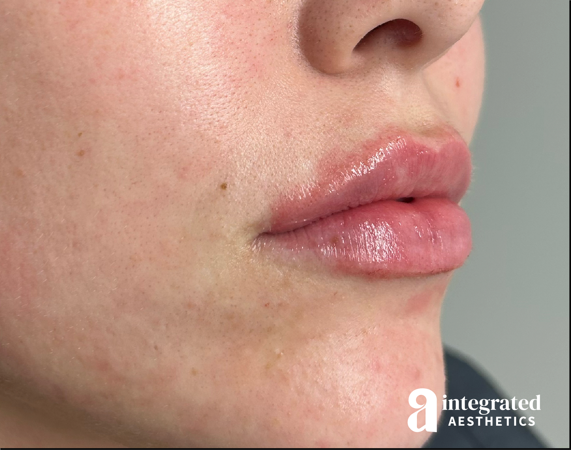 Lip Filler Before & After Gallery - Patient 320036 - Image 4