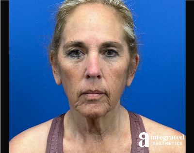 Facelift & Neck Lift Before & After Gallery - Patient 155800 - Image 1