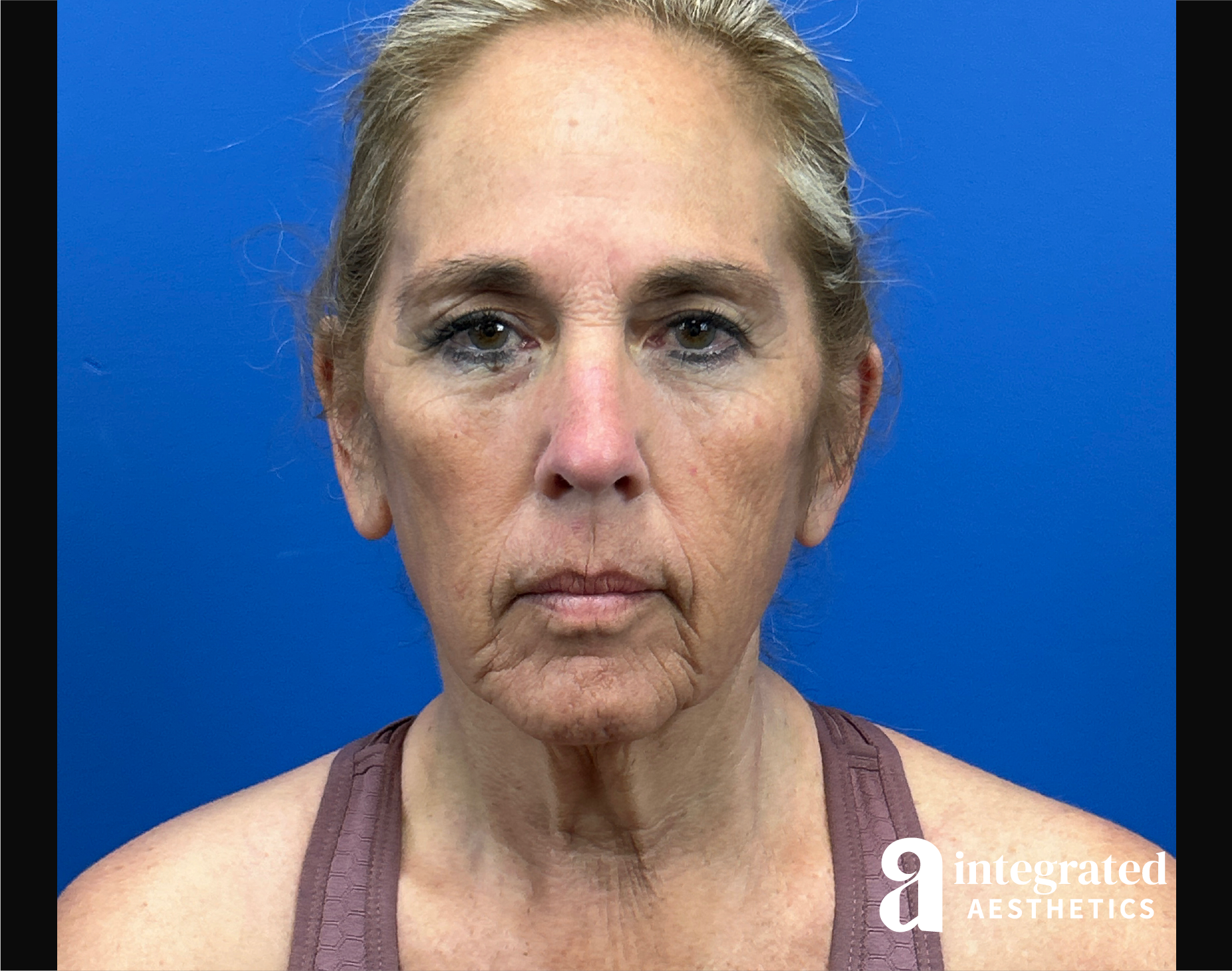 Facelift & Neck Lift Before & After Gallery - Patient 155800 - Image 1