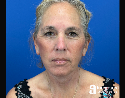 Facelift & Neck Lift Before & After Gallery - Patient 155800 - Image 2