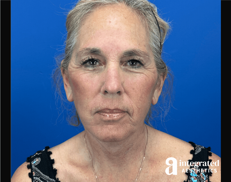 Facelift & Neck Lift Before & After Gallery - Patient 155800 - Image 2