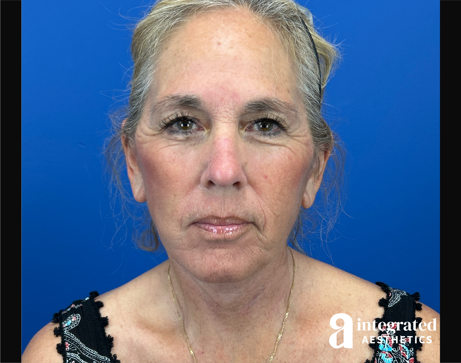 Facelift & Neck Lift Before & After Gallery - Patient 155800 - Image 2