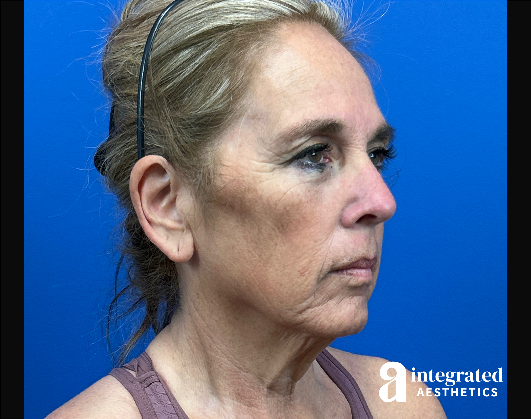 Facelift & Neck Lift Before & After Gallery - Patient 155800 - Image 3