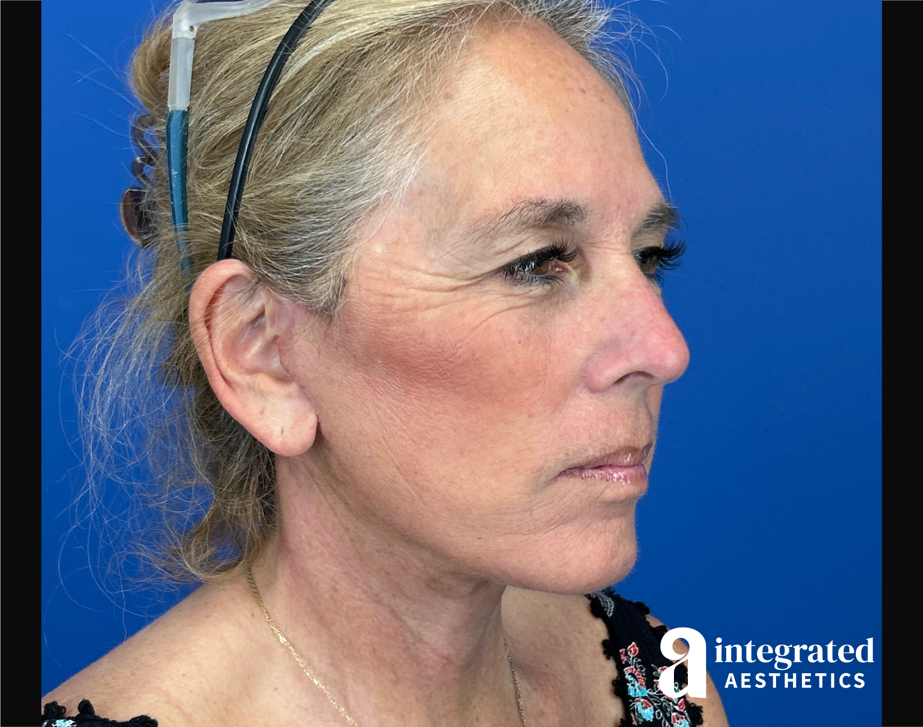 Facelift & Neck Lift Before & After Gallery - Patient 155800 - Image 4