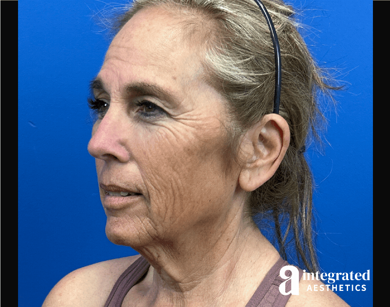 Facelift & Neck Lift Before & After Gallery - Patient 155800 - Image 5