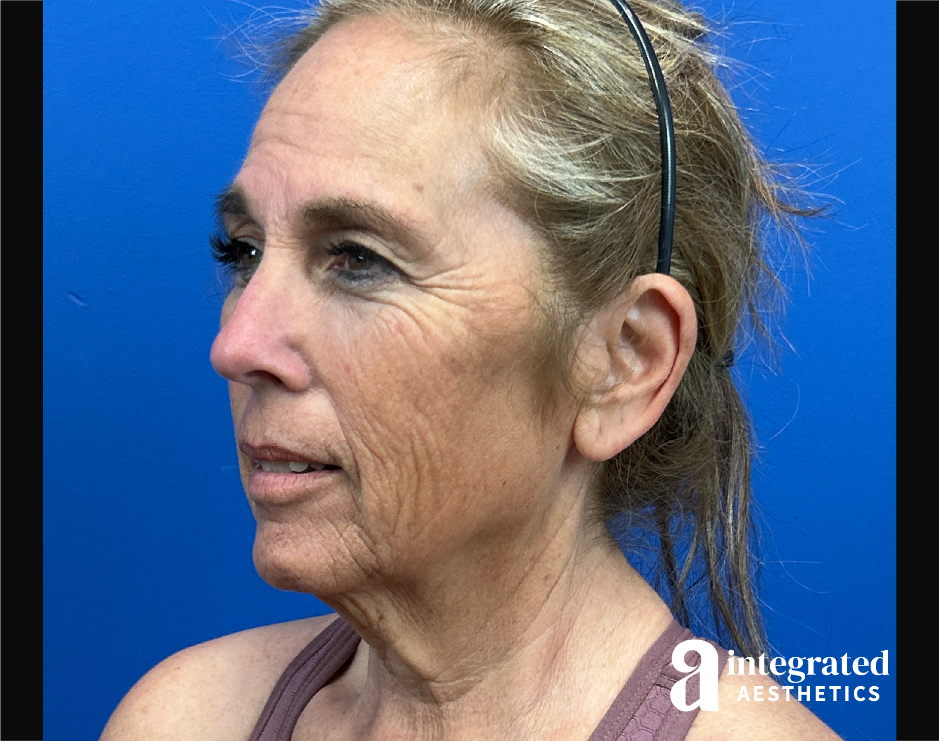 Facelift & Neck Lift Before & After Gallery - Patient 155800 - Image 5