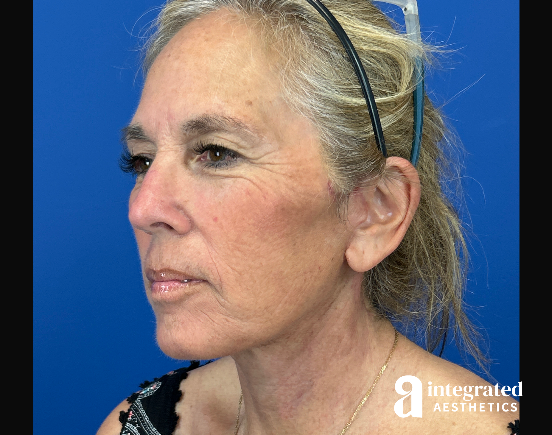 Facelift & Neck Lift Before & After Gallery - Patient 155800 - Image 6