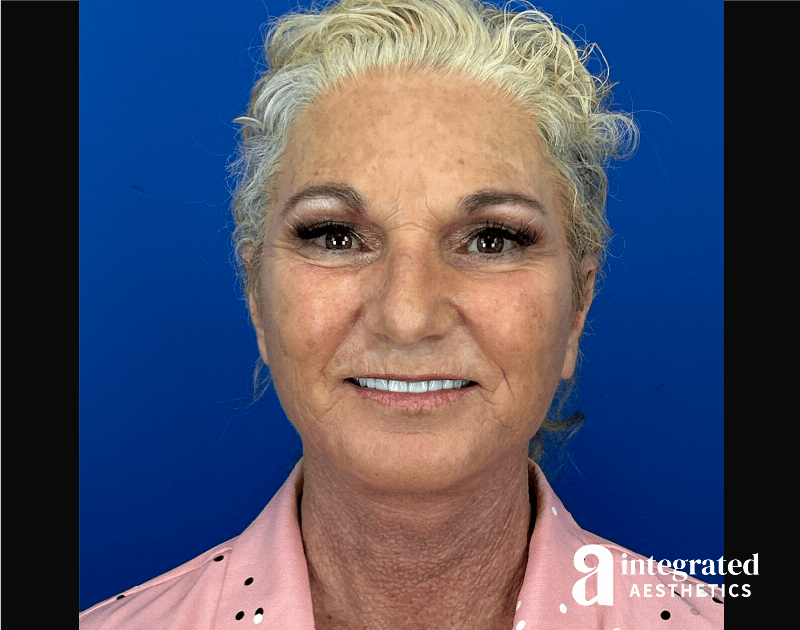 Facelift & Neck Lift Before & After Gallery - Patient 341686 - Image 2