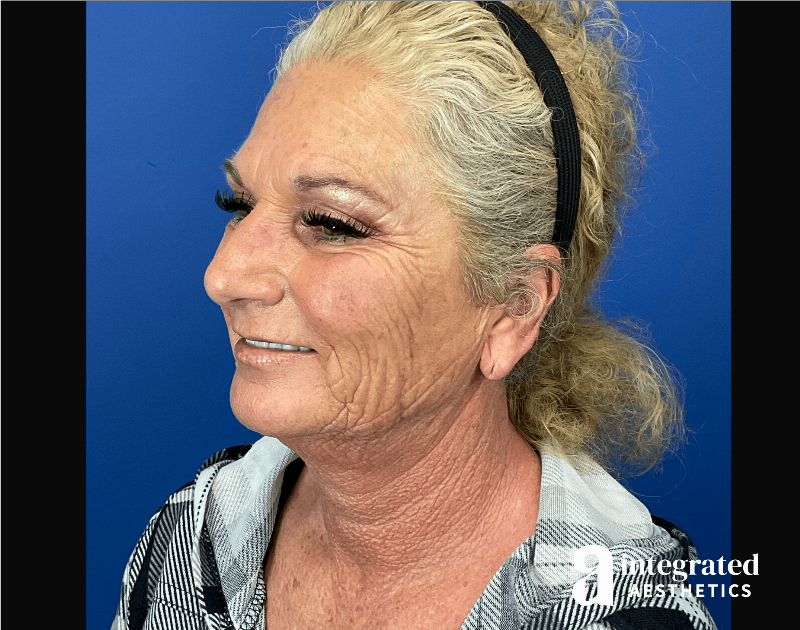 Facelift & Neck Lift Before & After Gallery - Patient 341686 - Image 3