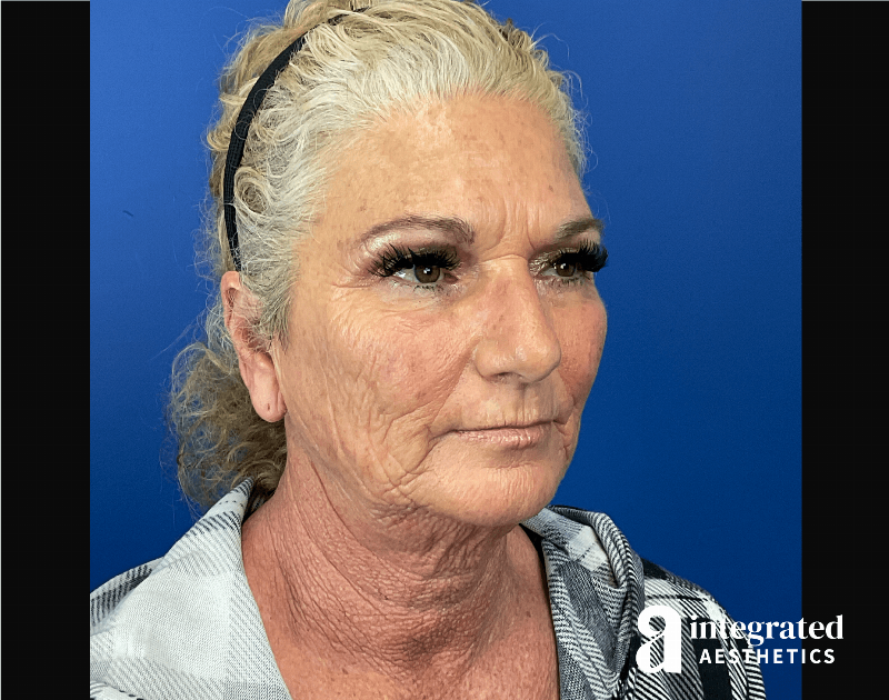 Facelift & Neck Lift Before & After Gallery - Patient 341686 - Image 5