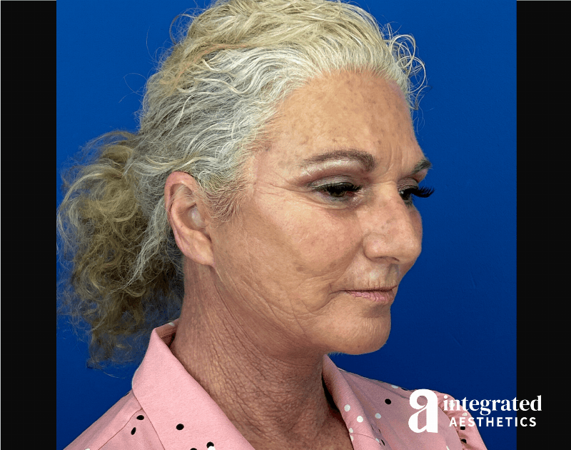 Facelift & Neck Lift Before & After Gallery - Patient 341686 - Image 6