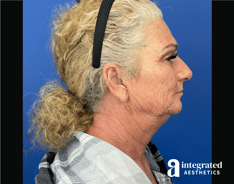 Facelift & Neck Lift Before & After Gallery - Patient 341686 - Image 7