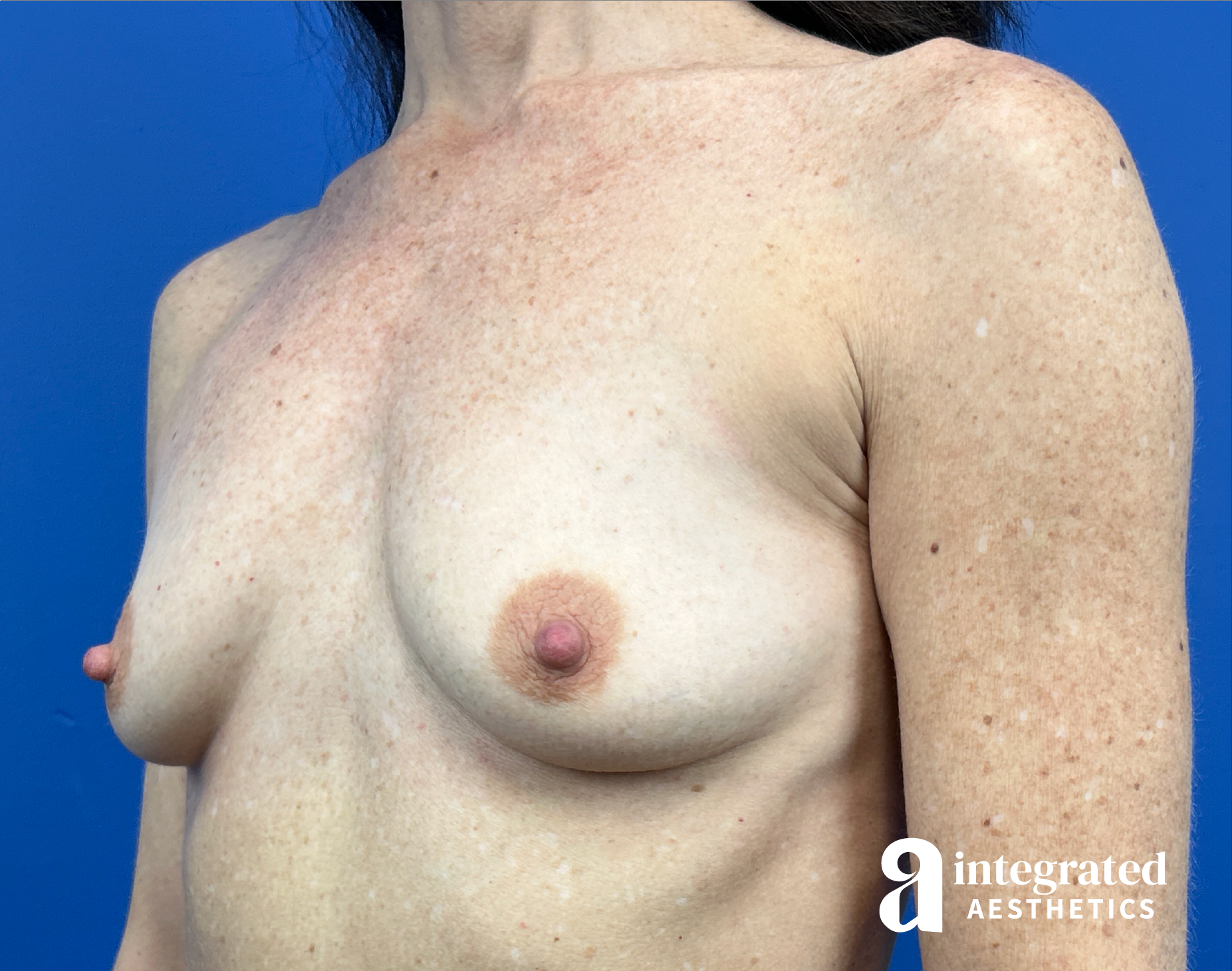 Breast Augmentation Before & After Gallery - Patient 330476 - Image 3