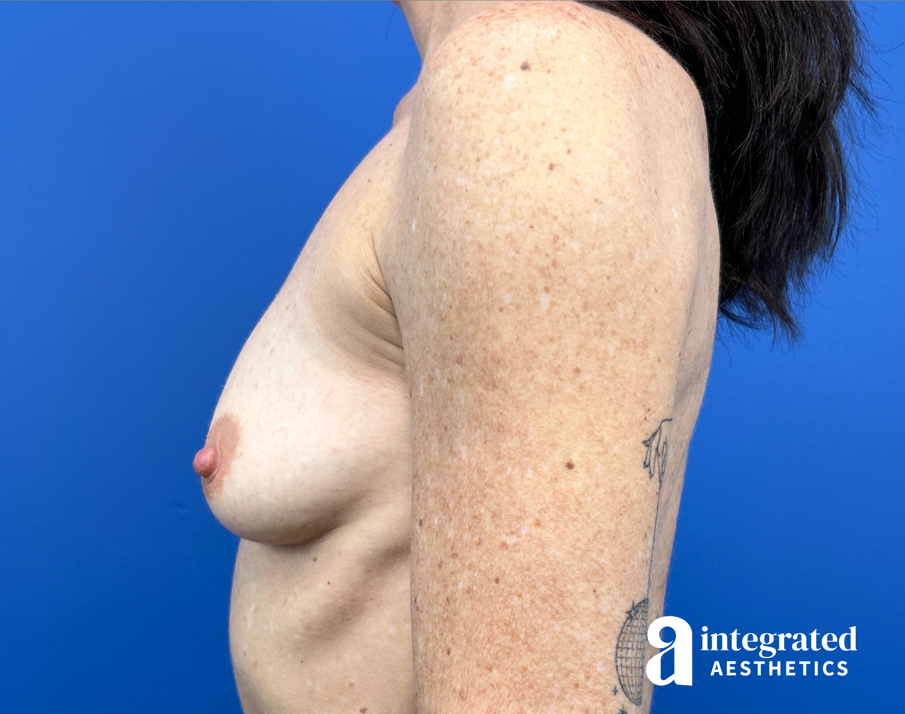 Breast Augmentation Before & After Gallery - Patient 330476 - Image 7