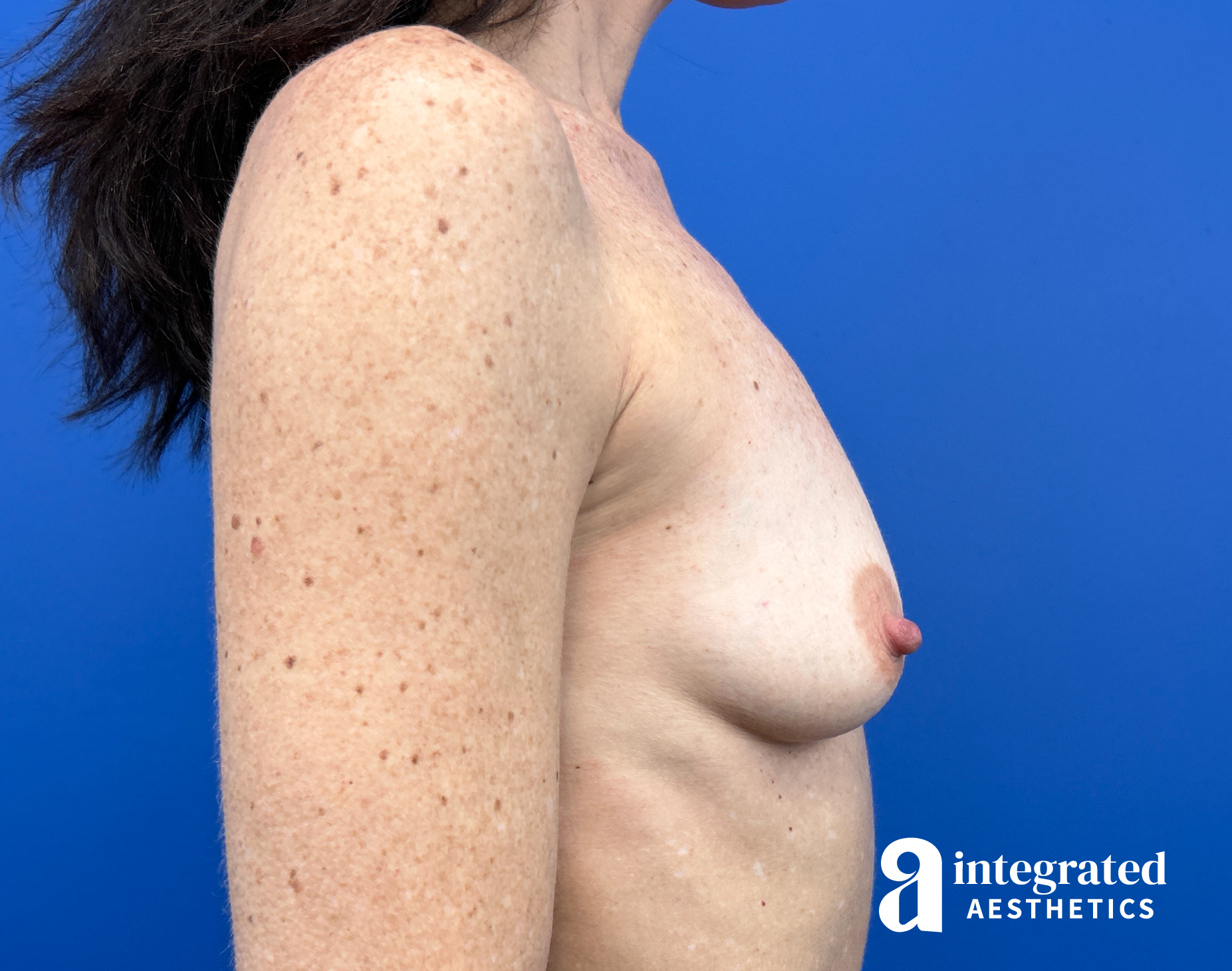 Breast Augmentation Before & After Gallery - Patient 330476 - Image 9