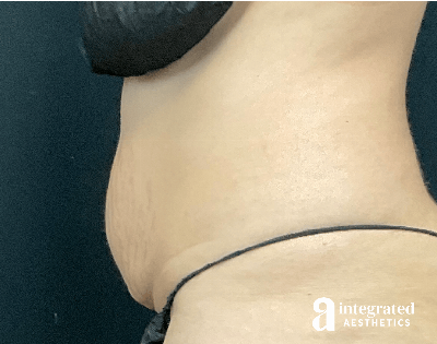 CoolSculpting Before & After Gallery - Patient 428325 - Image 1