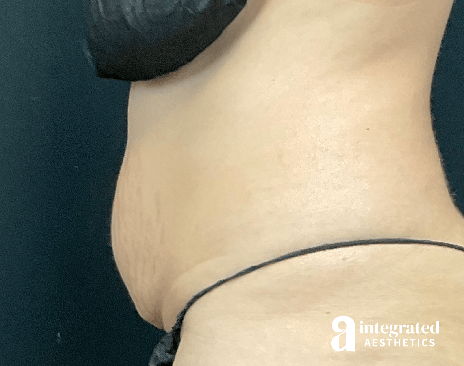 CoolSculpting Before & After Gallery - Patient 428325 - Image 1