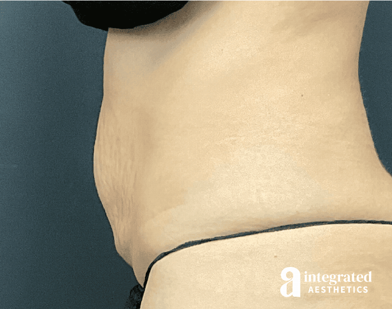 CoolSculpting Before & After Gallery - Patient 428325 - Image 2