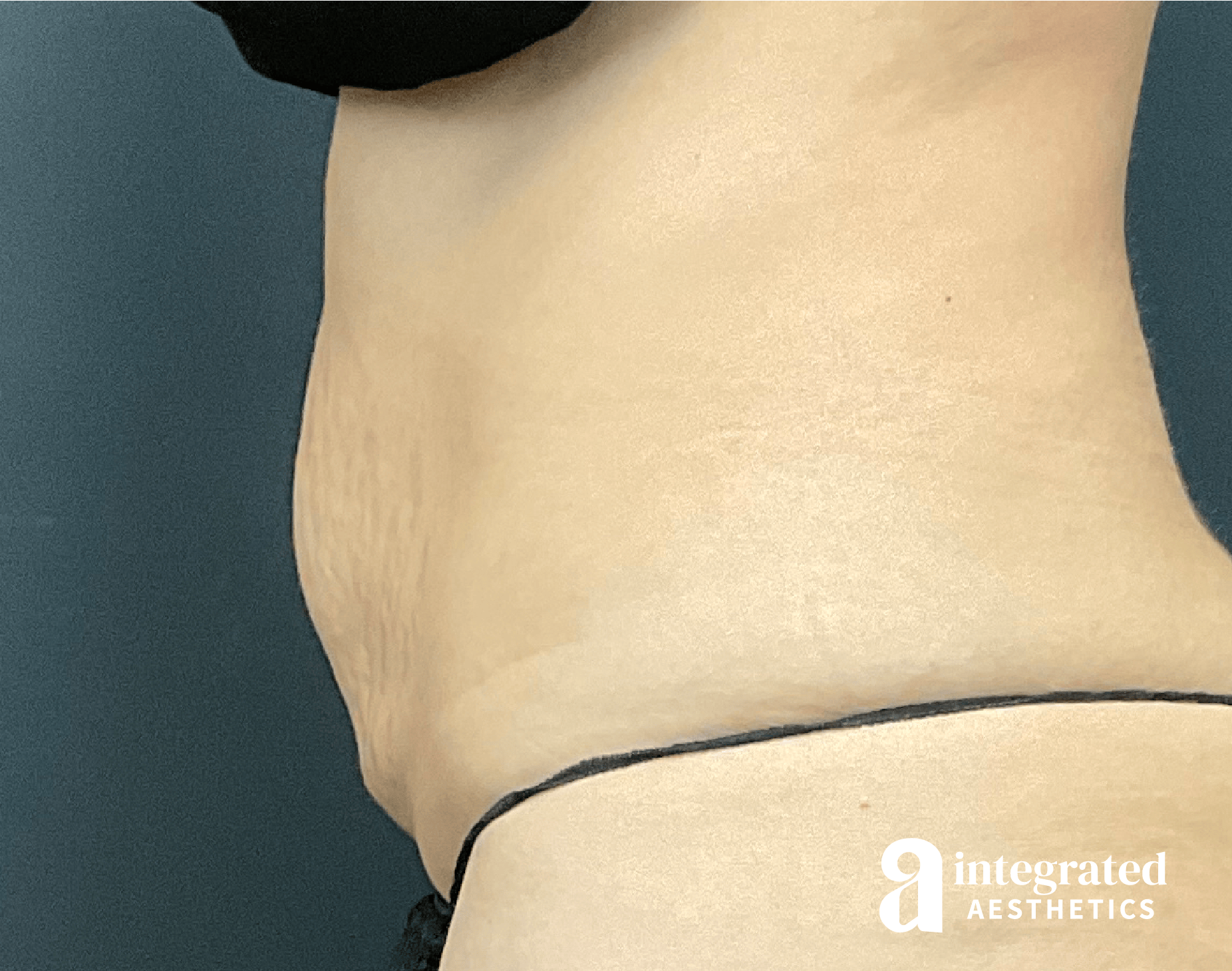 CoolSculpting Before & After Gallery - Patient 428325 - Image 2