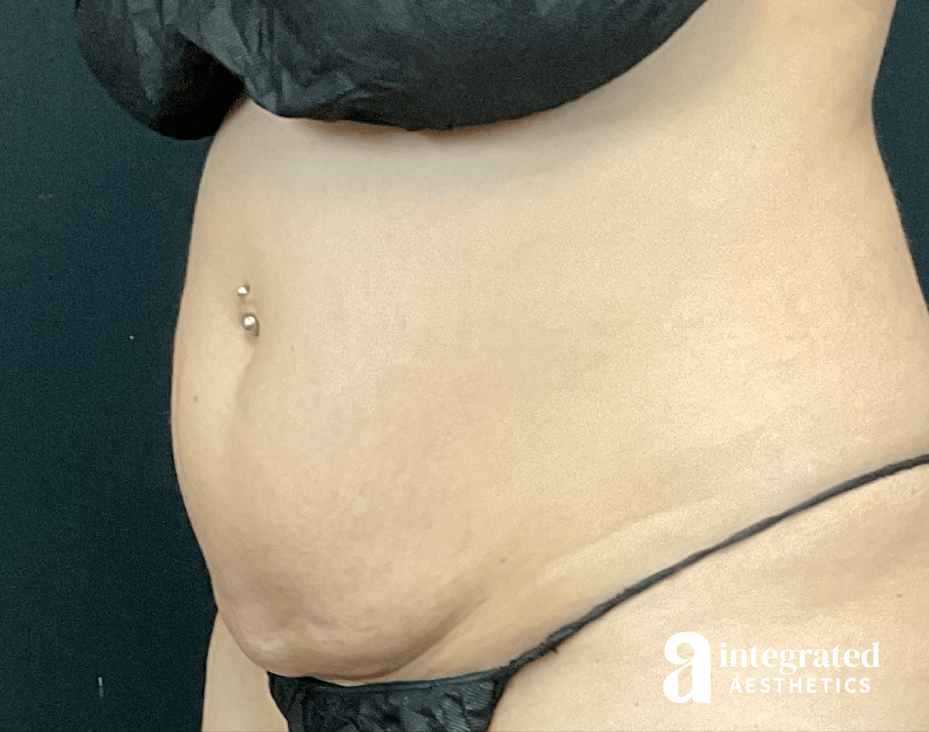 CoolSculpting Before & After Gallery - Patient 428325 - Image 3