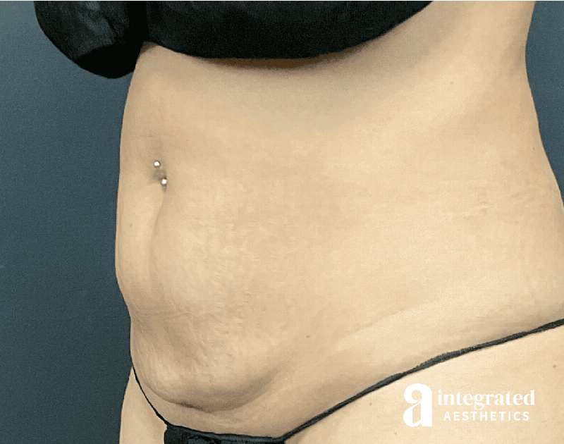 CoolSculpting Before & After Gallery - Patient 428325 - Image 4