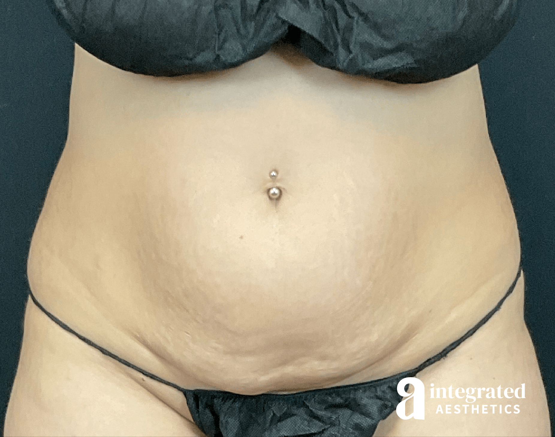 CoolSculpting Before & After Gallery - Patient 428325 - Image 5