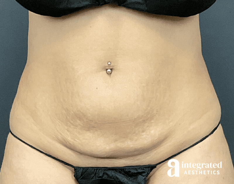 CoolSculpting Before & After Gallery - Patient 428325 - Image 6