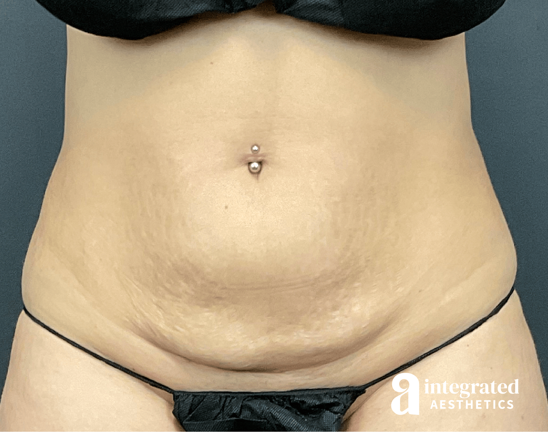 CoolSculpting Before & After Gallery - Patient 428325 - Image 6