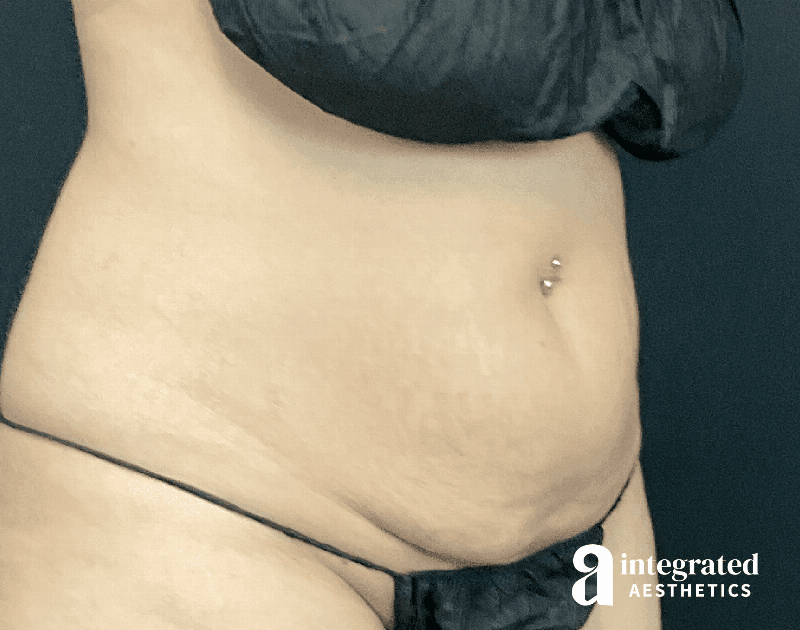 CoolSculpting Before & After Gallery - Patient 428325 - Image 7