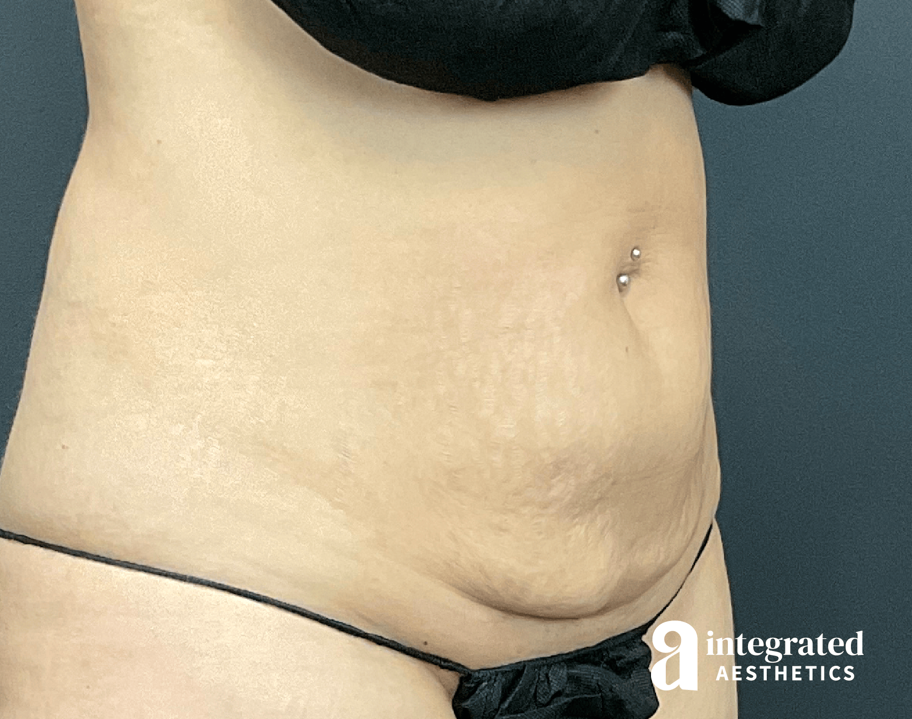 CoolSculpting Before & After Gallery - Patient 428325 - Image 8