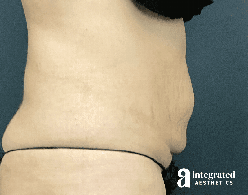 CoolSculpting Before & After Gallery - Patient 428325 - Image 10