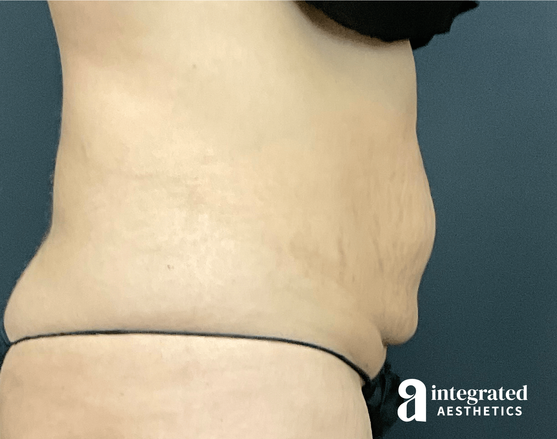 CoolSculpting Before & After Gallery - Patient 428325 - Image 10