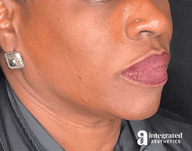 Dermal Fillers Before & After Gallery - Patient 406883 - Image 1