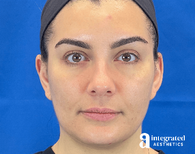 Dermal Fillers Before & After Gallery - Patient 240319 - Image 1