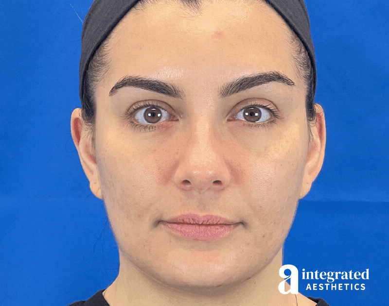 Dermal Fillers Before & After Gallery - Patient 240319 - Image 1