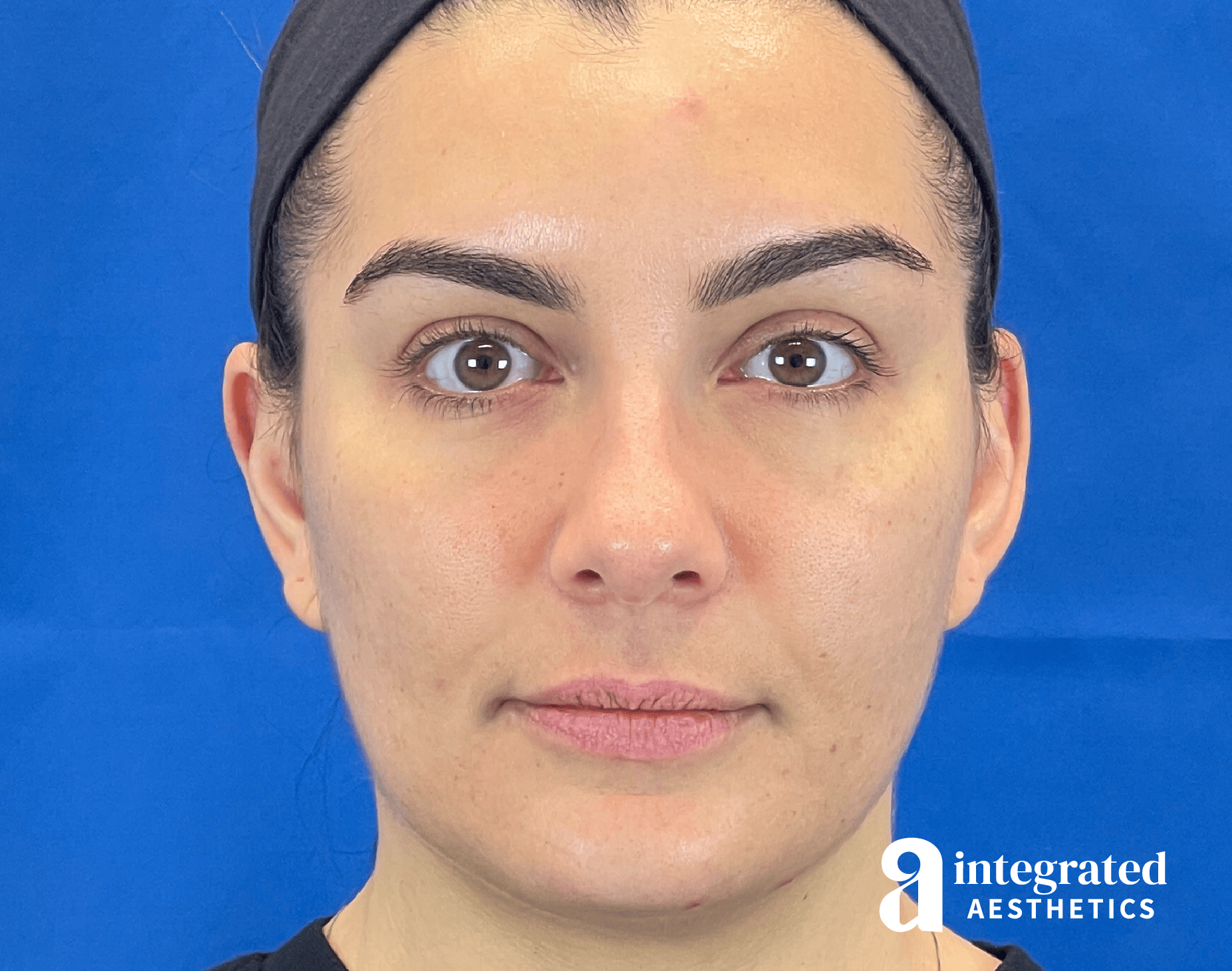 Wrinkle Relaxers Before & After Gallery - Patient 346906 - Image 1