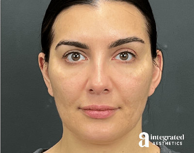 Dermal Fillers Before & After Gallery - Patient 240319 - Image 2