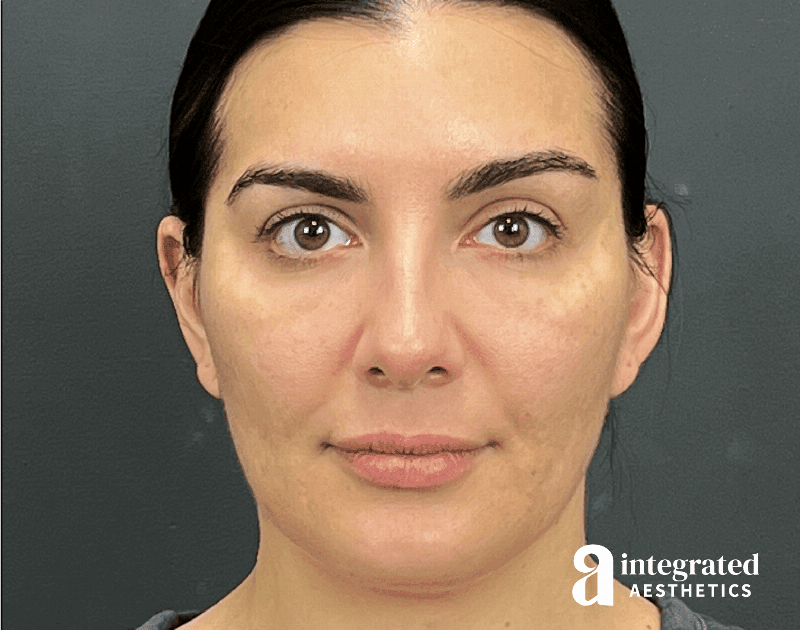 Dermal Fillers Before & After Gallery - Patient 240319 - Image 2