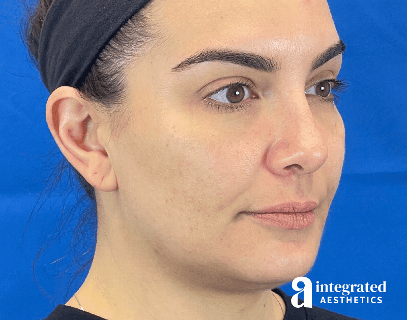 Dermal Fillers Before & After Gallery - Patient 240319 - Image 3