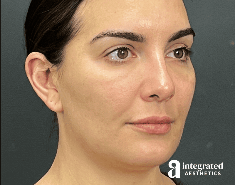 Dermal Fillers Before & After Gallery - Patient 240319 - Image 4