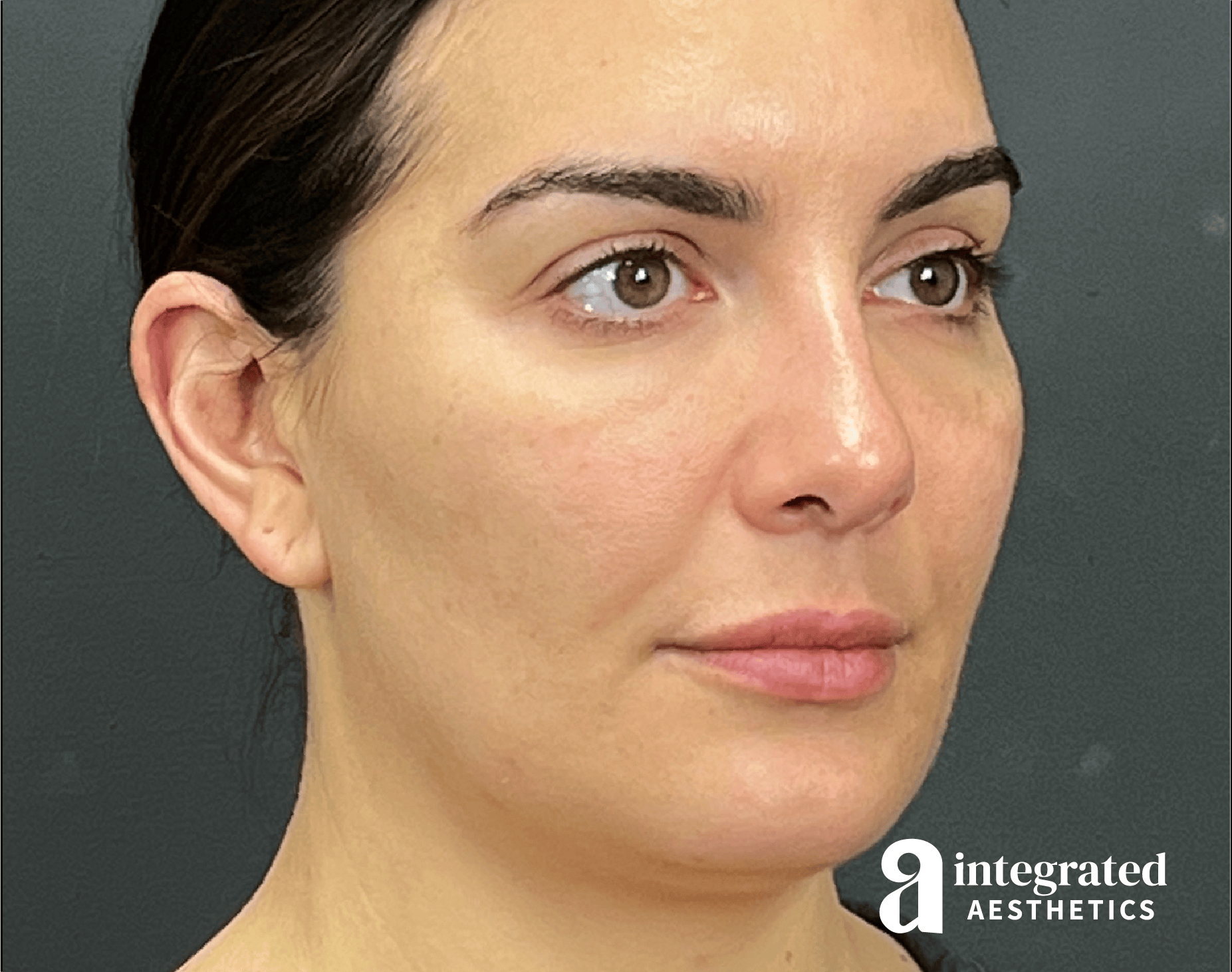 Wrinkle Relaxers Before & After Gallery - Patient 346906 - Image 4