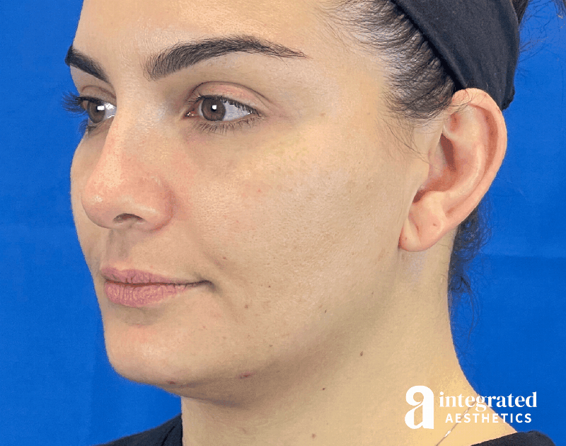 Dermal Fillers Before & After Gallery - Patient 240319 - Image 5