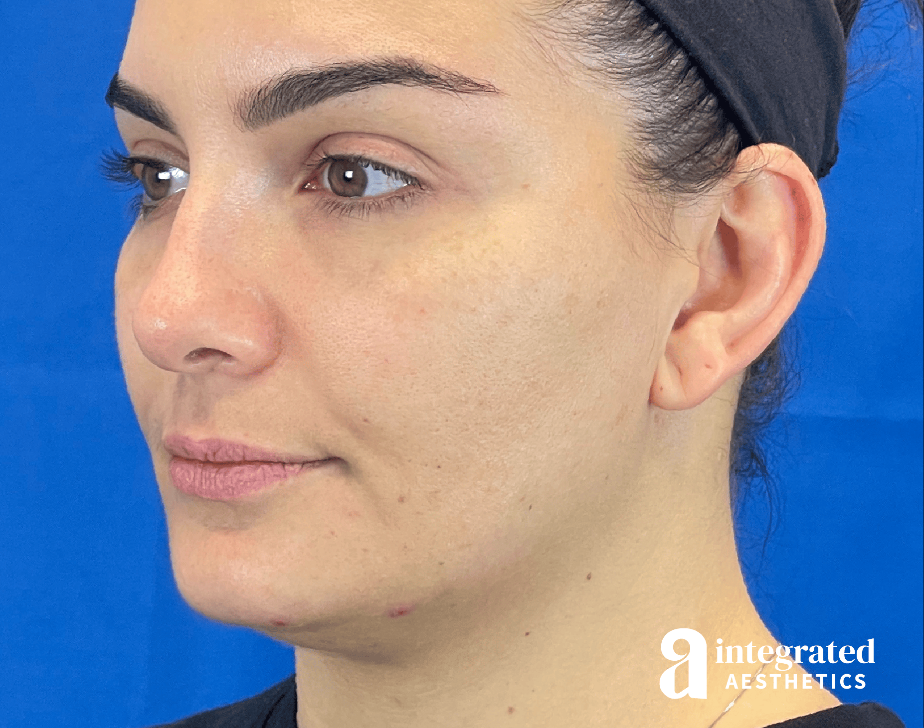 Wrinkle Relaxers Before & After Gallery - Patient 346906 - Image 5