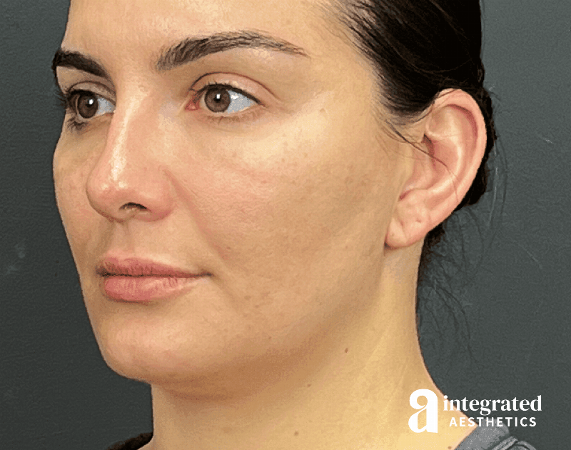 Dermal Fillers Before & After Gallery - Patient 240319 - Image 6