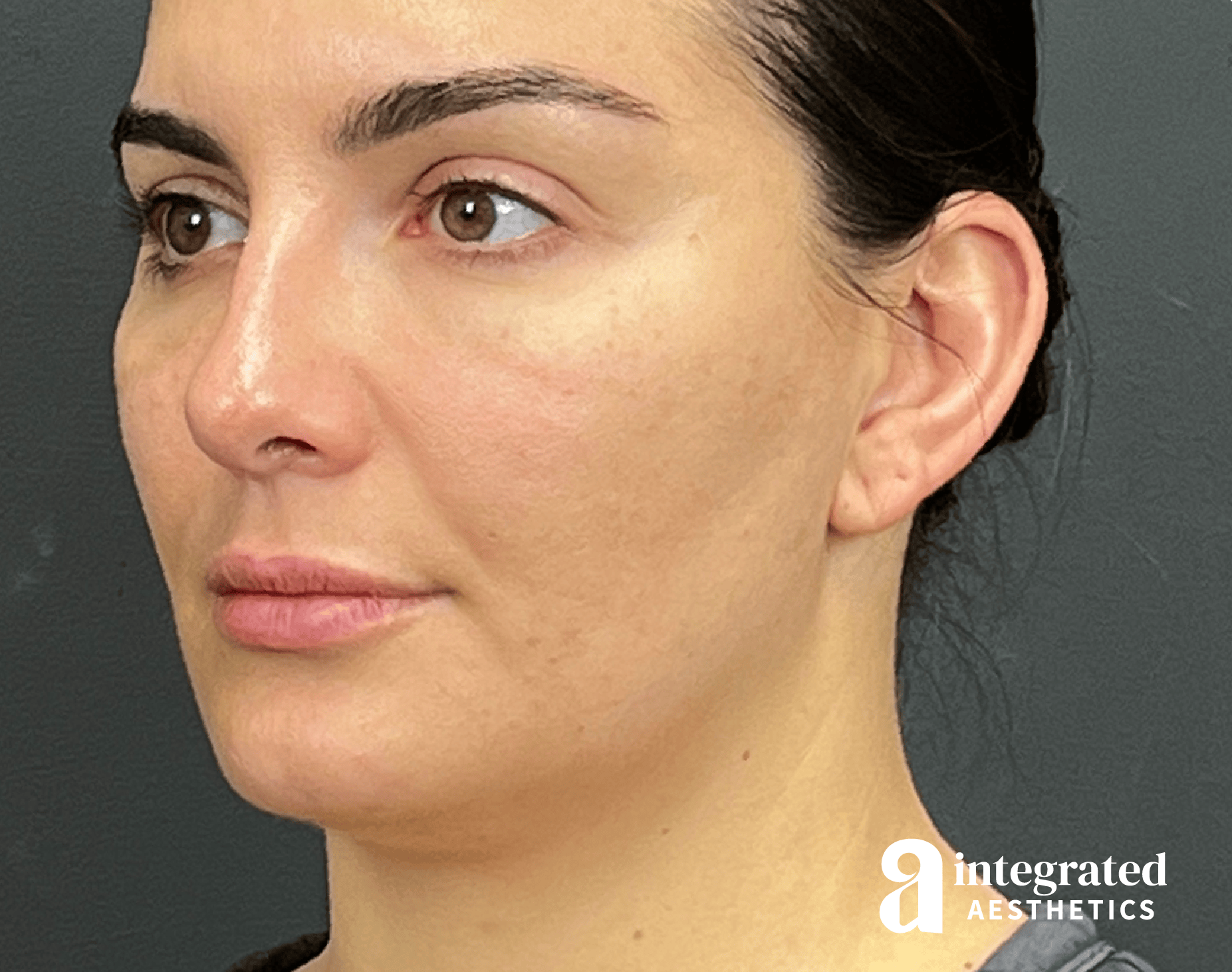 Wrinkle Relaxers Before & After Gallery - Patient 346906 - Image 6