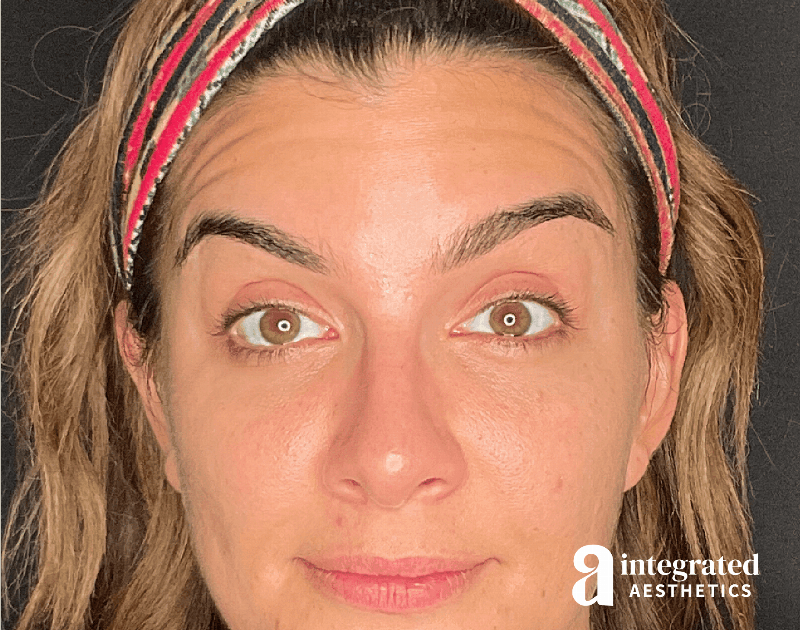 Wrinkle Relaxers Before & After Gallery - Patient 284499 - Image 1