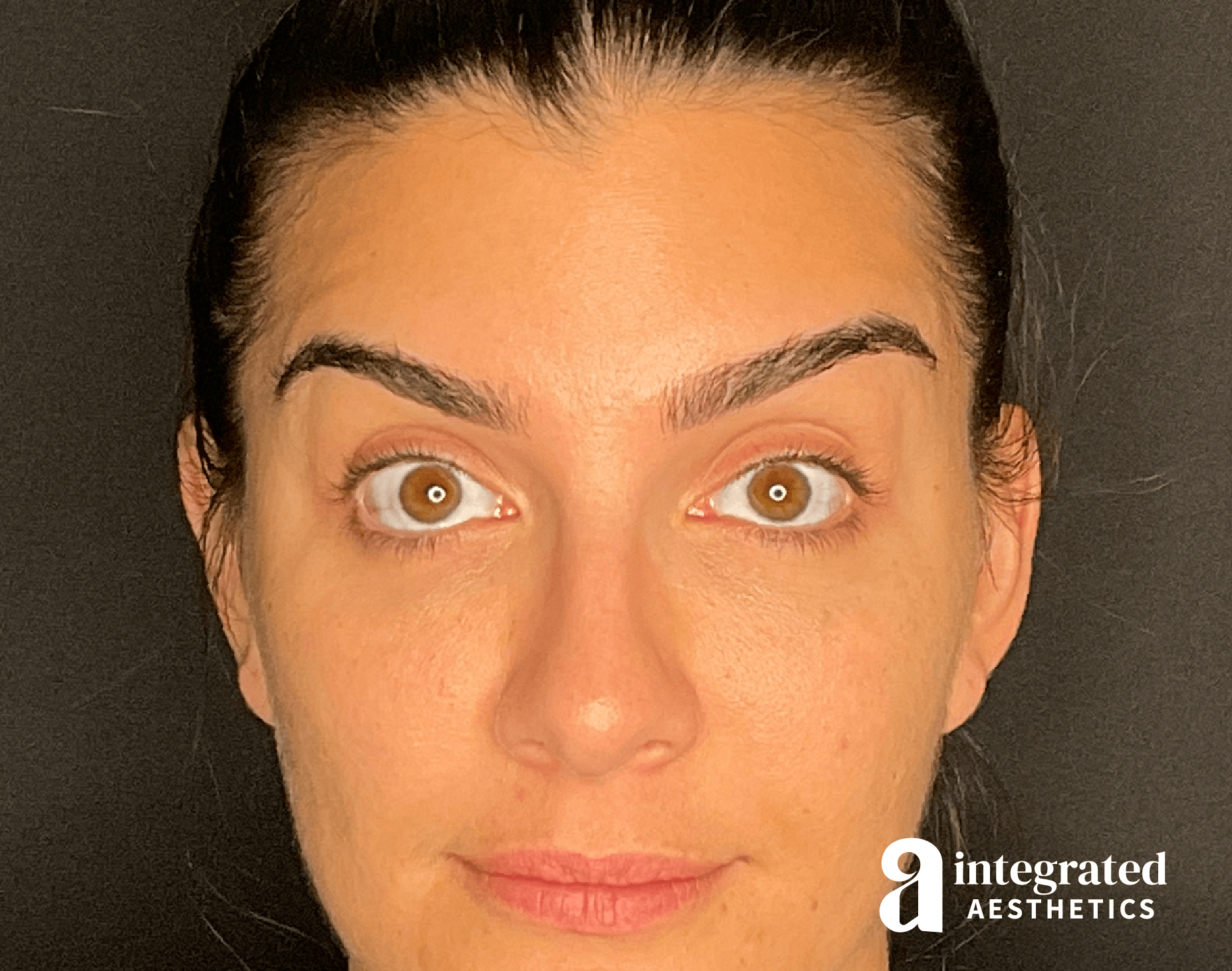 Wrinkle Relaxers Before & After Gallery - Patient 284499 - Image 2